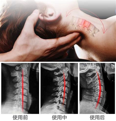 反弓|頸椎反弓：症狀、病因及如何治療